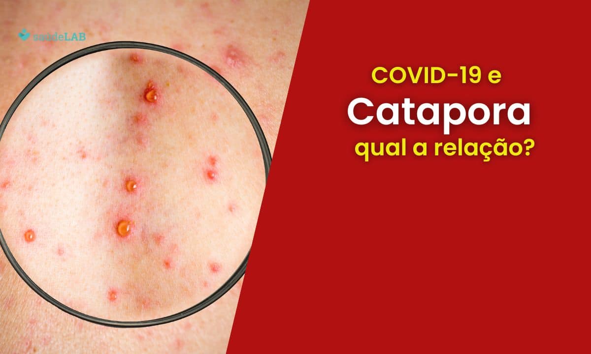 Mulher pegou catapora por duas vezes: entenda a relação entre herpes zóster e a covid-19 1 Herpes Zoster.