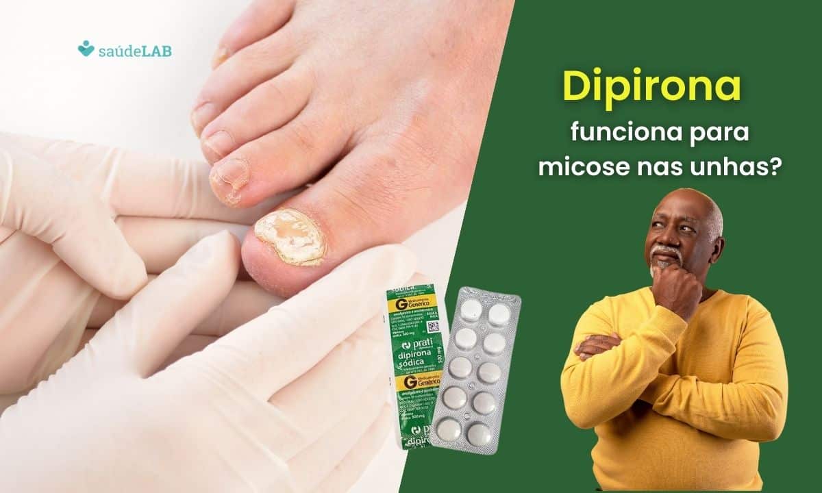 Dipirona para micose nas unhas funciona? Saiba como tratar o problema 1 Dipirona para micose nas unhas funciona.
