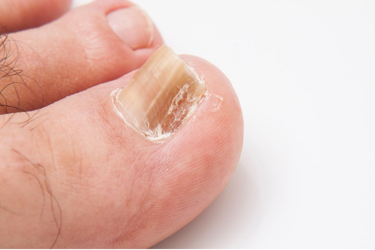 Tipos de micose no pé: conheça as principais infecções fúngicas e como tratá-las 3 Onicomicose.
