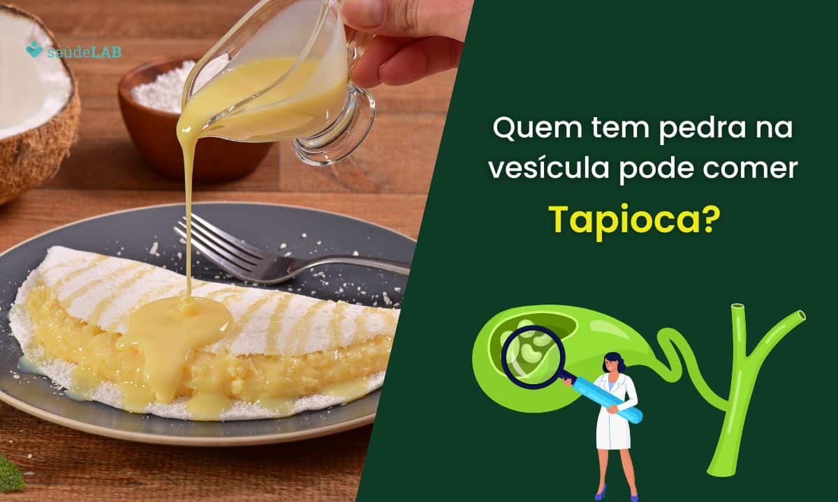 Quem tem pedra na vesícula pode comer tapioca? Clique aqui e descubra 1 Quem tem pedra na vesícula pode comer tapioca.