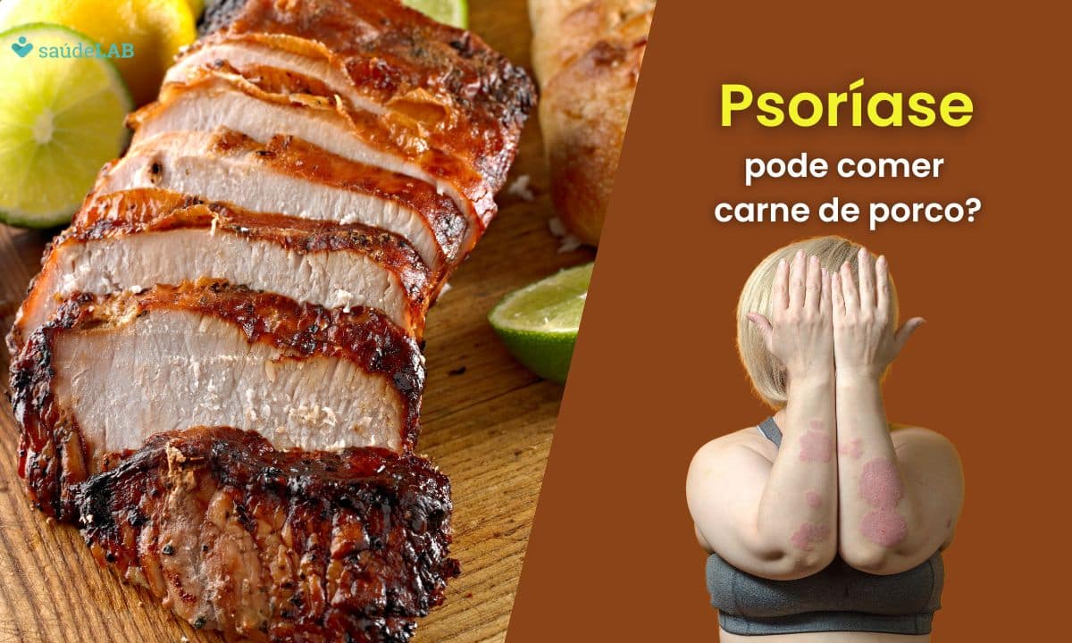 Quem tem psoríase pode comer carne de porco? Entenda as restrições alimentares da doença 1 Quem tem psoríase pode comer carne de porco.