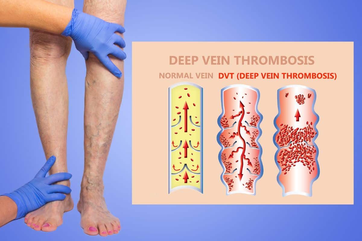 Quem tem trombose pode trabalhar normalmente? Entenda os cuidados essenciais 2 Quem tem trombose trabalha normalmente.