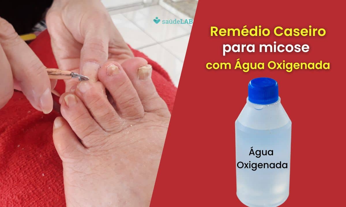Remédio caseiro para micose de unha com água oxigenada: saiba como fazer 1 Remédio caseiro para micose de unha com água oxigenada.