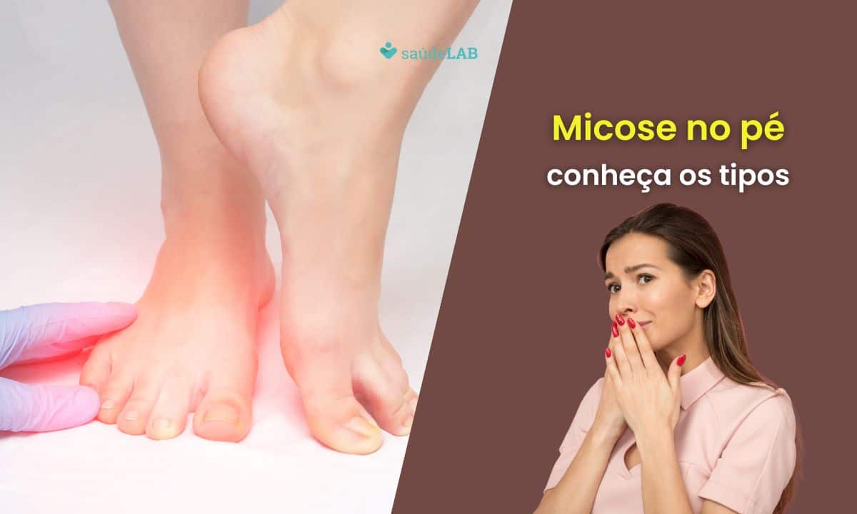 Tipos de micose no pé: conheça as principais infecções fúngicas e como tratá-las 1 Tipos de micose no pé.