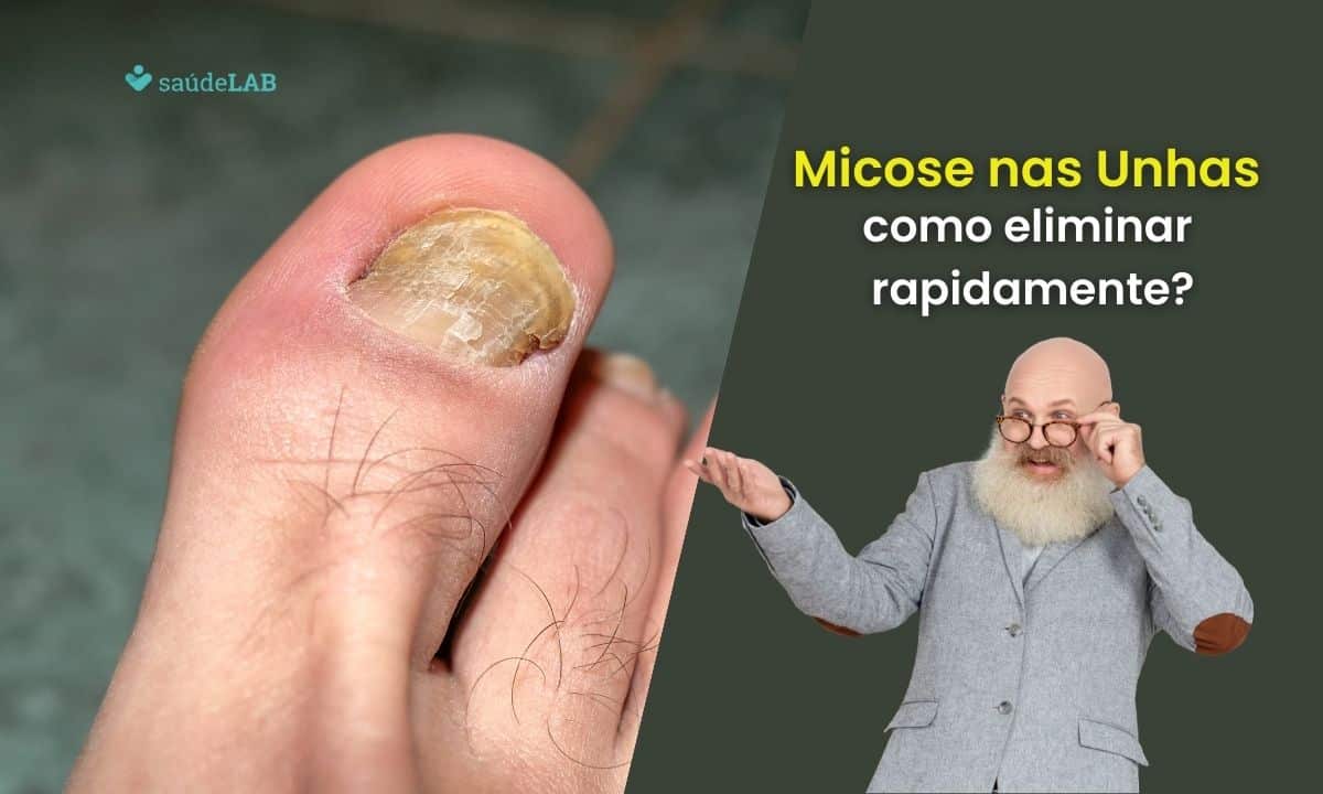 Como acabar com fungos nas unhas rapidamente: descubra 5 dicas de ouro 1 Como acabar com fungos nas unhas rapidamente.