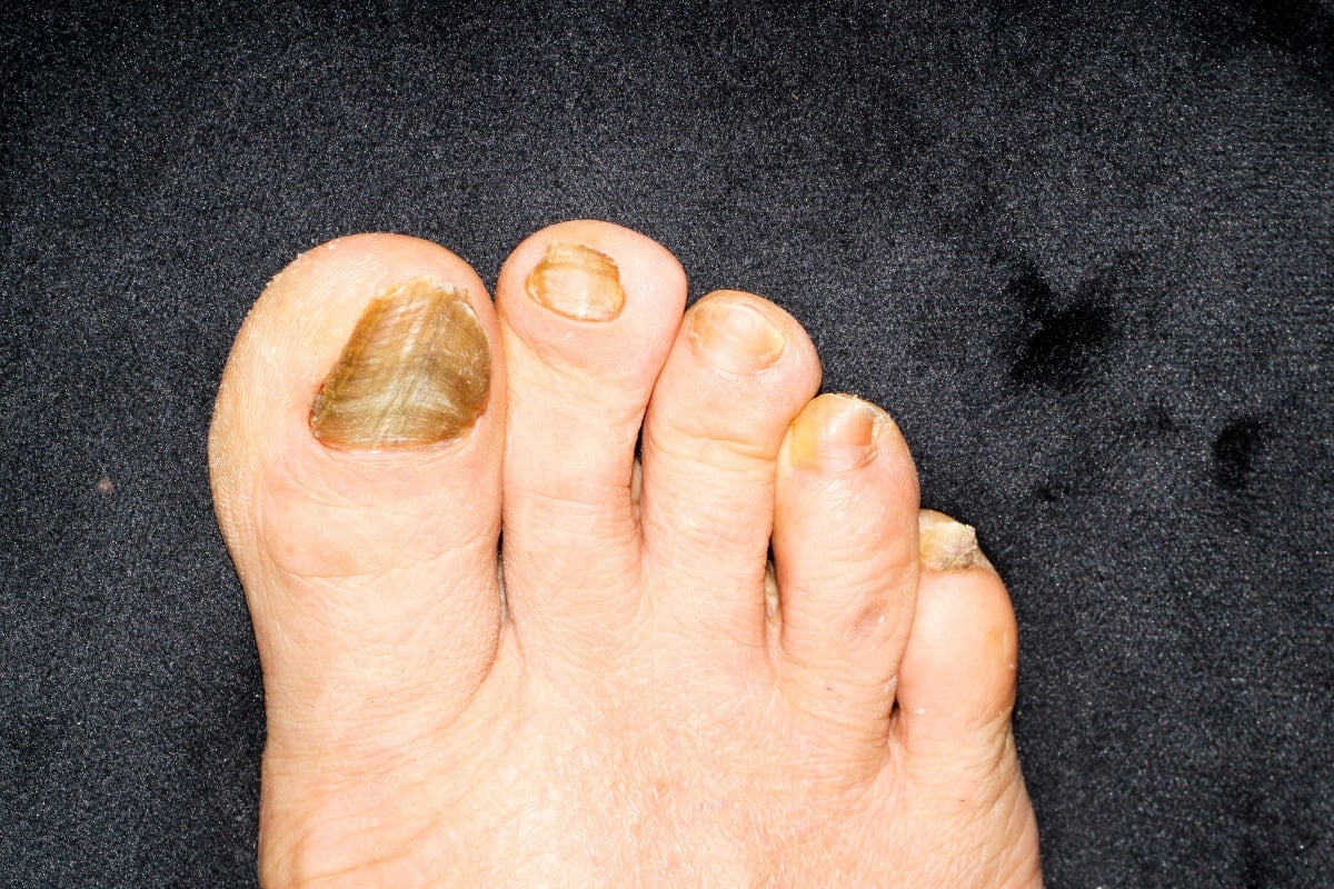 Como acabar com fungos nas unhas rapidamente: descubra 5 dicas de ouro 2 Como acabar com fungos nas unhas rapidamente