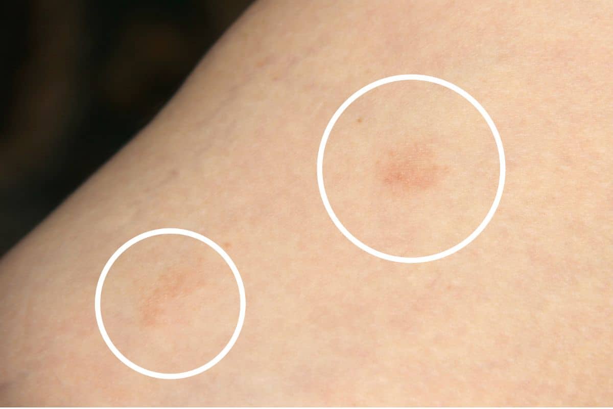Tipos de micose no pé: conheça as principais infecções fúngicas e como tratá-las 4 Ptiríase vesicolor.
