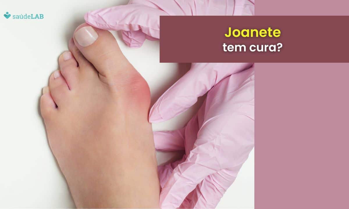 Joanete tem cura? Entenda as causas, complicações e o tratamento adequado 1 Joanete tem cura.