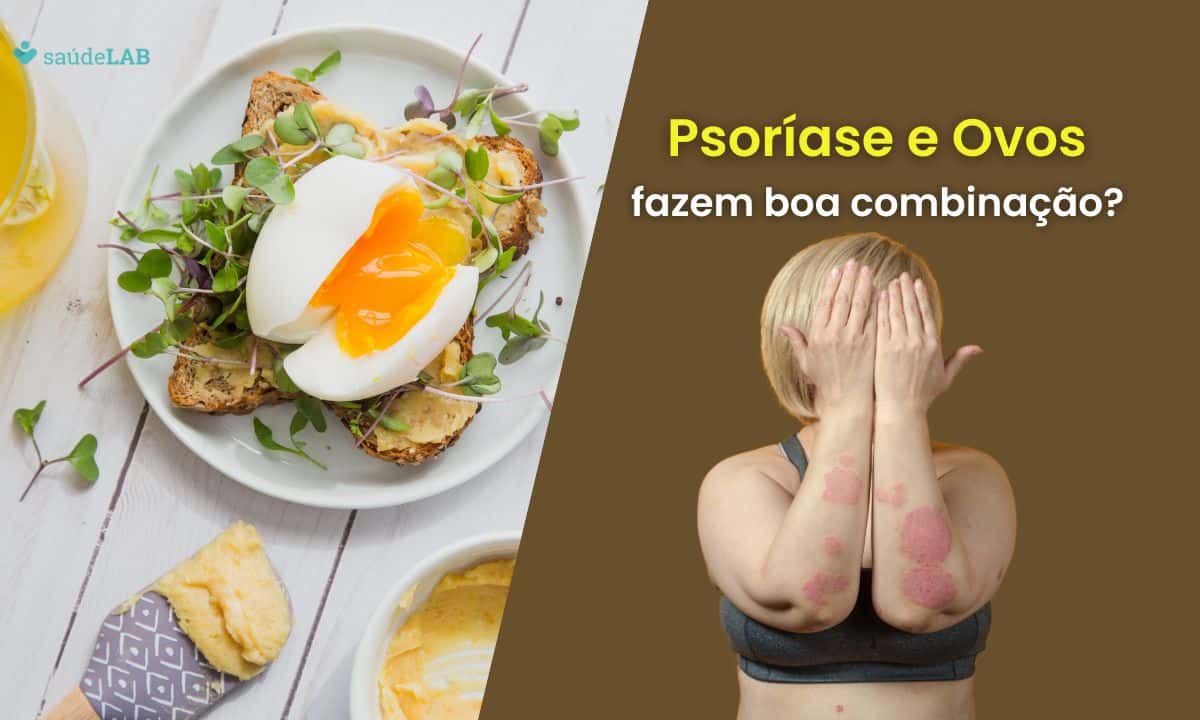 Quem tem psoríase pode comer ovo? Saiba os efeitos na alimentação na doença 1 Quem tem psoríase pode comer ovo