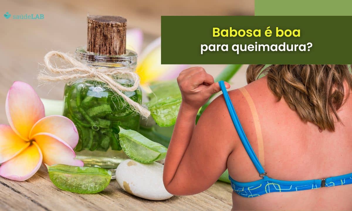 Babosa é boa para queimadura? Aprenda e evite complicações 1 Babosa é boa para queimadura.