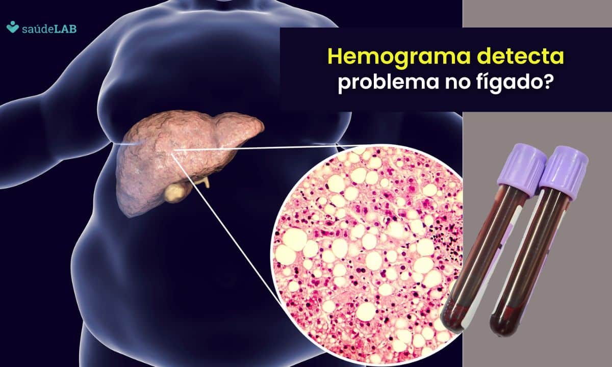 Hemograma detecta problema no fígado? Descubra agora a finalidade do exame 1 Hemograma detecta problema no fígado.
