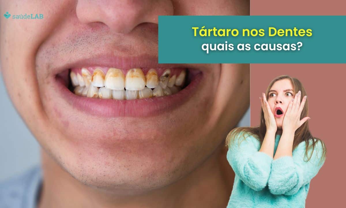 O que causa tártaro nos dentes? Descubra como evitar e tratar esse problema 1 O que causa tártaro nos dentes.