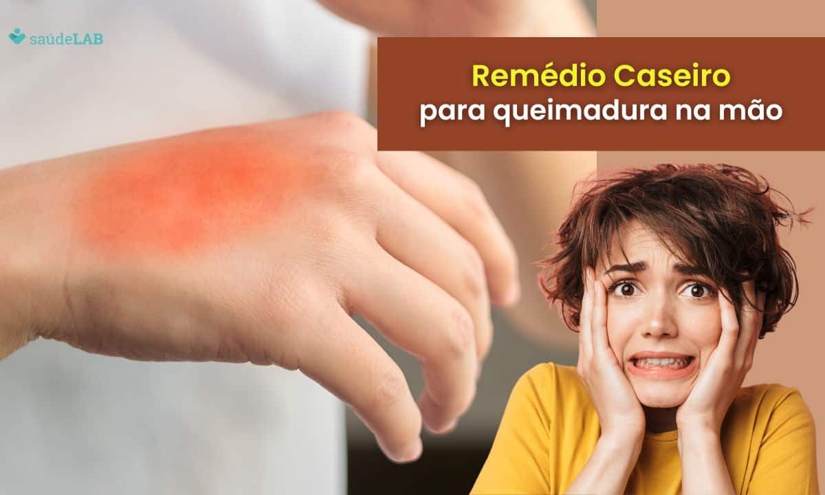 Remédio Caseiro para Queimadura na Mão: confira dicas poderosas para cuidar em casa 1 Remédio caseiro para queimadura na mão.