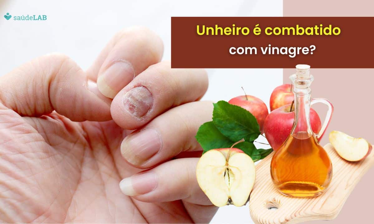 Vinagre é bom para unheiro? Saiba como esse problema pode ser realmente combatido 1 Vinagre é bom para unheiro.