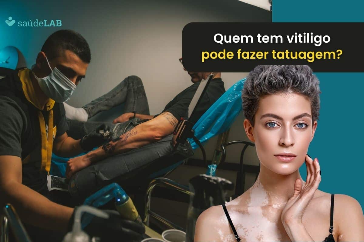 Quem tem vitiligo pode fazer tatuagem? Entenda a condição de saúde 1 Quem tem vitiligo pode fazer tatuagem.
