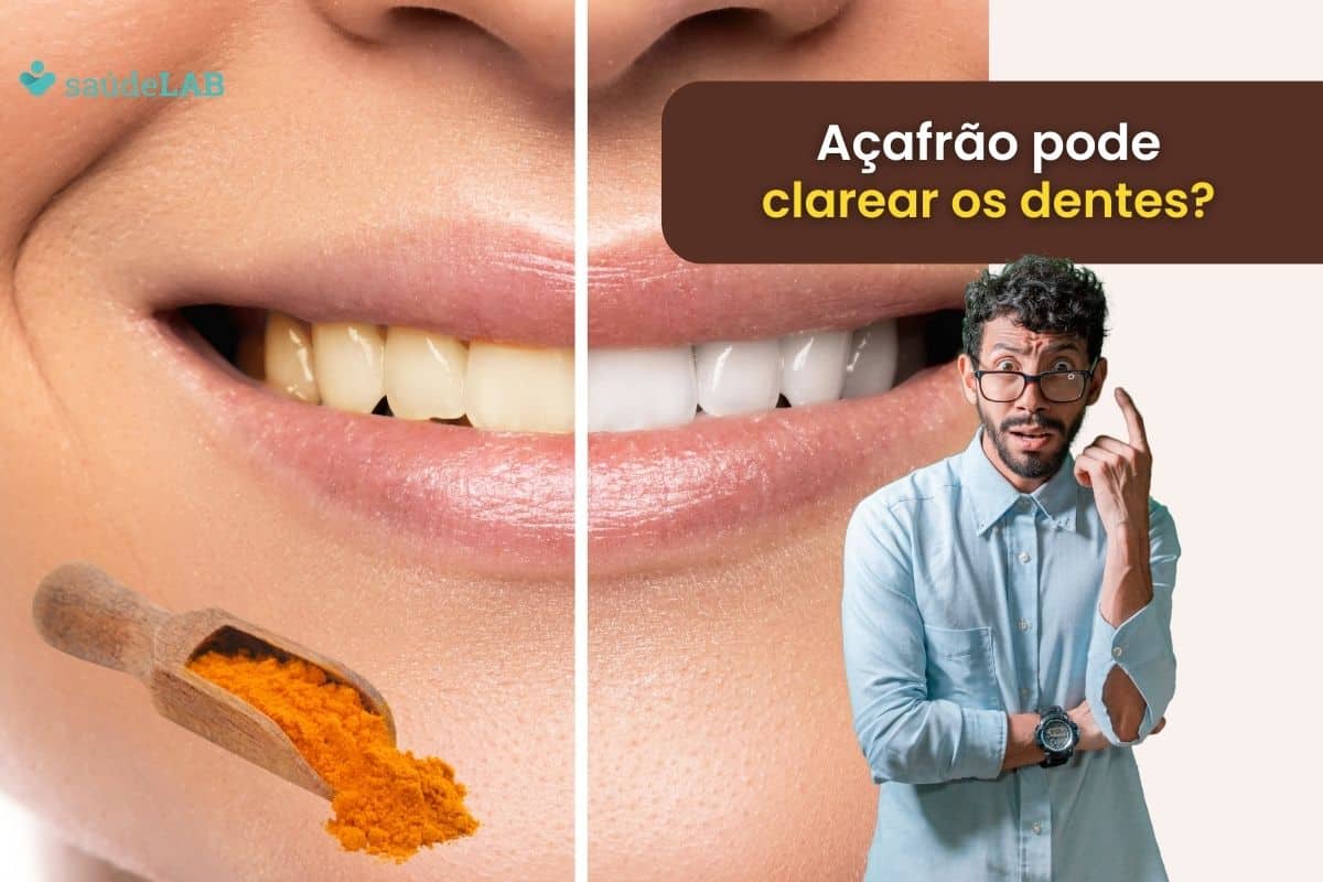 Açafrão clareia os dentes? Descubra se é uma boa ideia ou não 1 Açafrão clareia os dentes.
