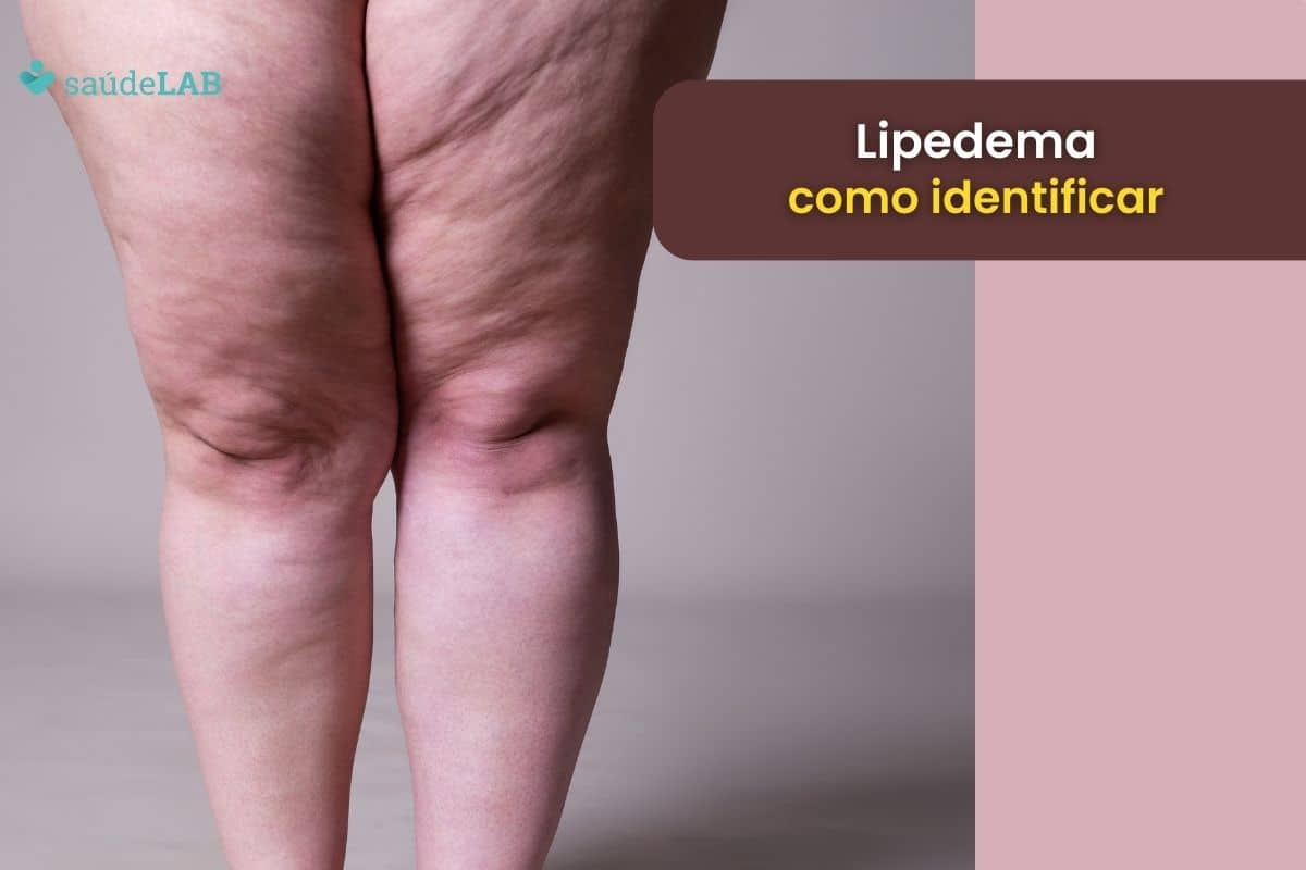 Lipedema: como identificar, e qual é a melhor maneira de combater ele? 1 lipedema como identificar.