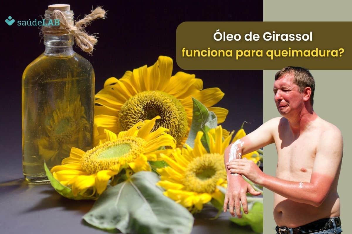 Pode usar o óleo de girassol para queimadura? Descubra se é mesmo uma boa opção 1 óleo de girassol para queimadura.