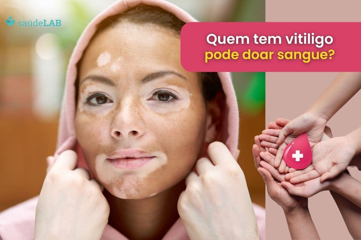 Quem tem vitiligo pode doar sangue? Fazer tatuagem? Saiba tudo aqui 1 quem tem vitiligo pode doar sangue.