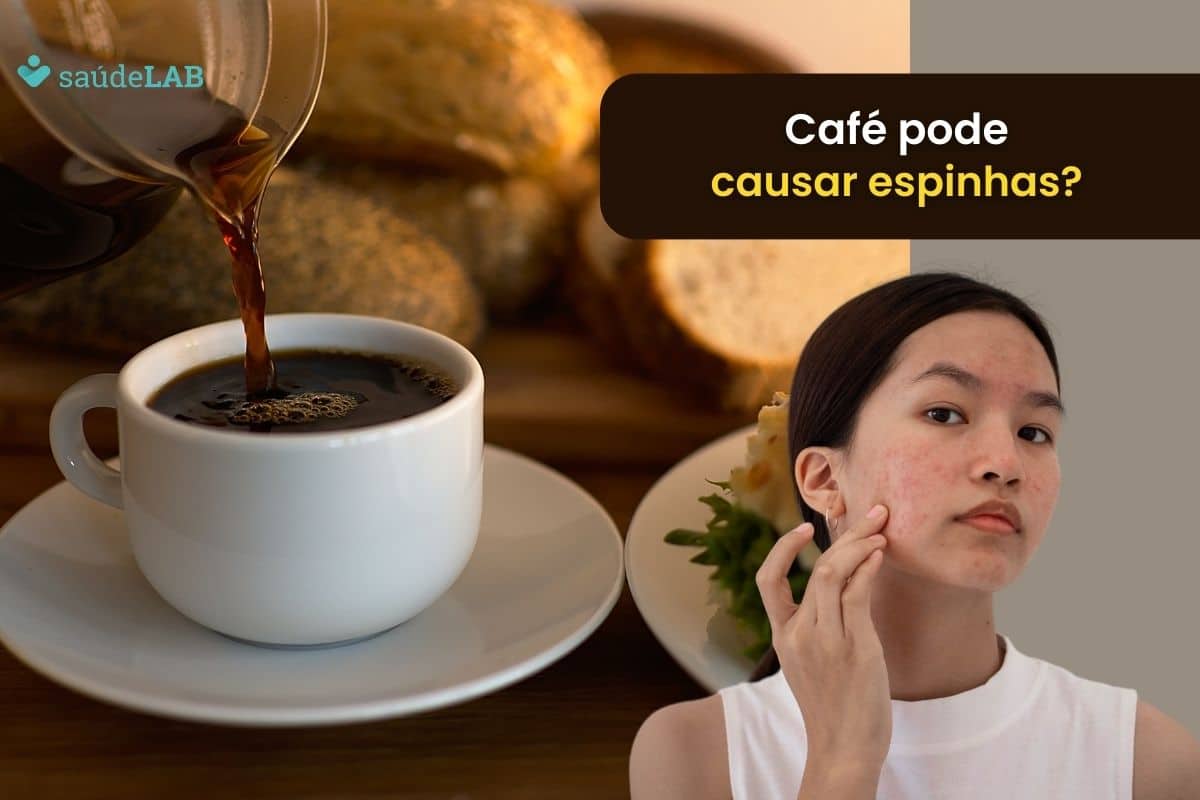 Café dá espinha? Descubra se é mito ou verdade 1 Café dá espinha.