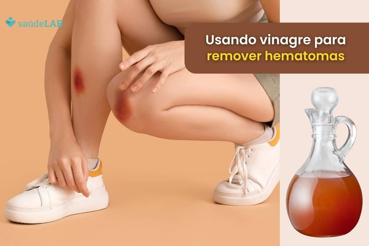 Como tirar roxo da pele com vinagre? Saiba como usar o produto e se livrar de hematomas 1 Como tirar roxo da pele com vinagre.