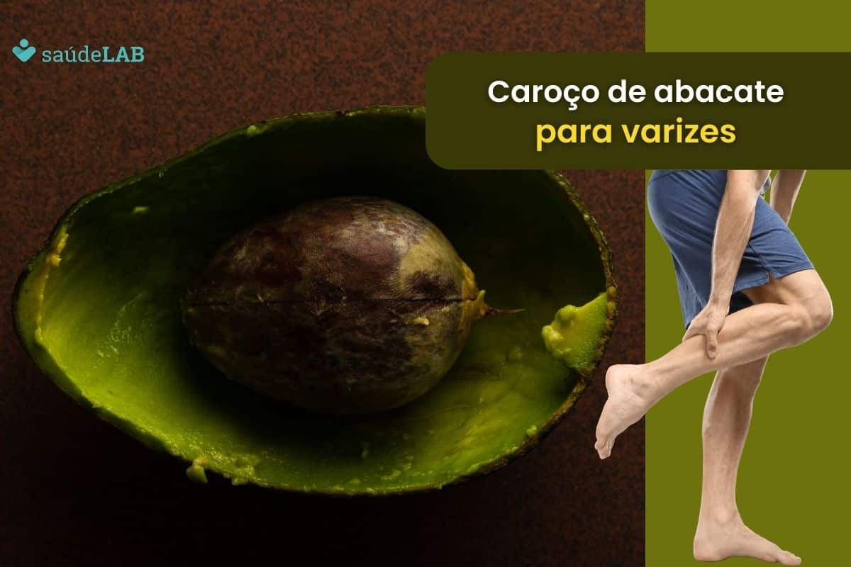 Caroço de abacate no álcool para varizes funciona mesmo? Saiba mais 1 caroço de abacate no álcool para varizes.