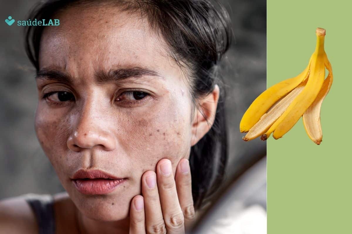 Passar casca de banana no rosto tira manchas da pele? Será que é perigoso? Entenda 1 passar casca de banana no rosto tira manchas.