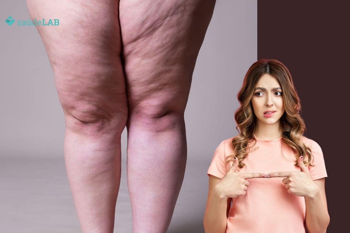 Lipedema: quais os sintomas e tratamentos? Tire sua dúvidas 1 lipedema.