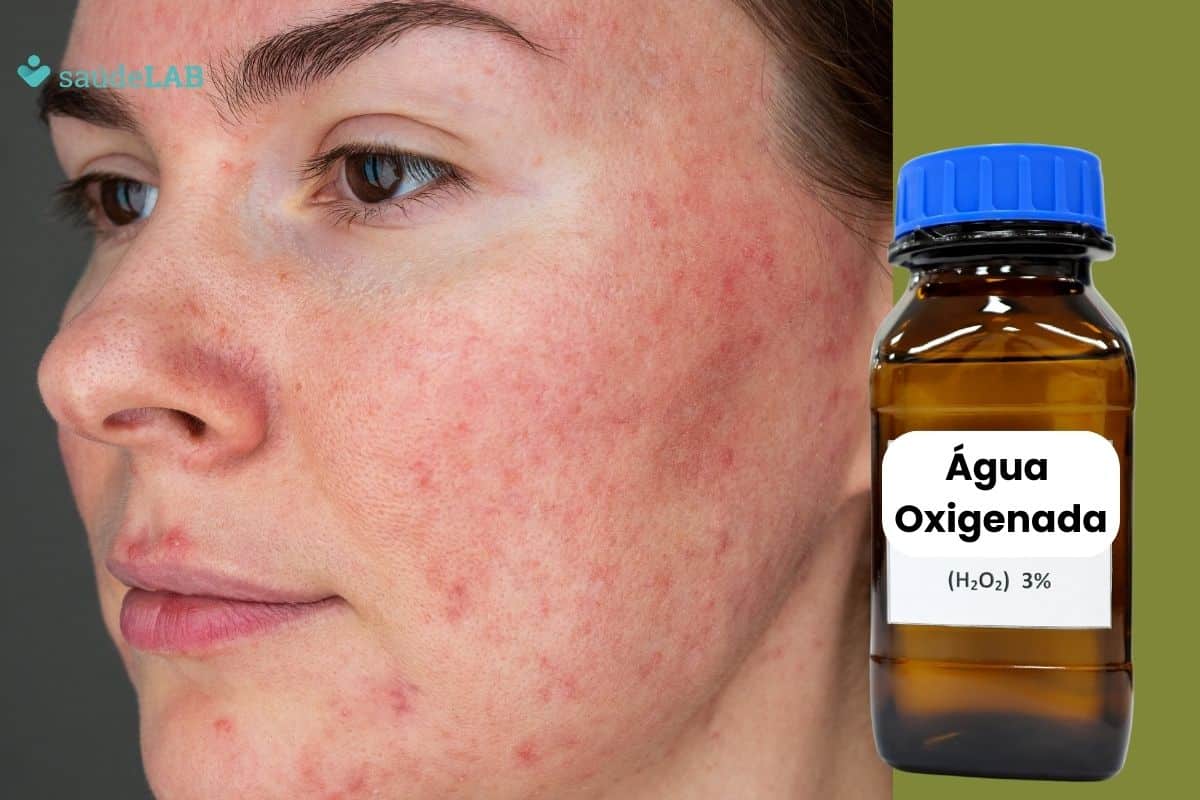 Rosácea tem cura definitiva com água oxigenada mesmo? Entenda 1 rosácea cura definitiva com água oxigenada.