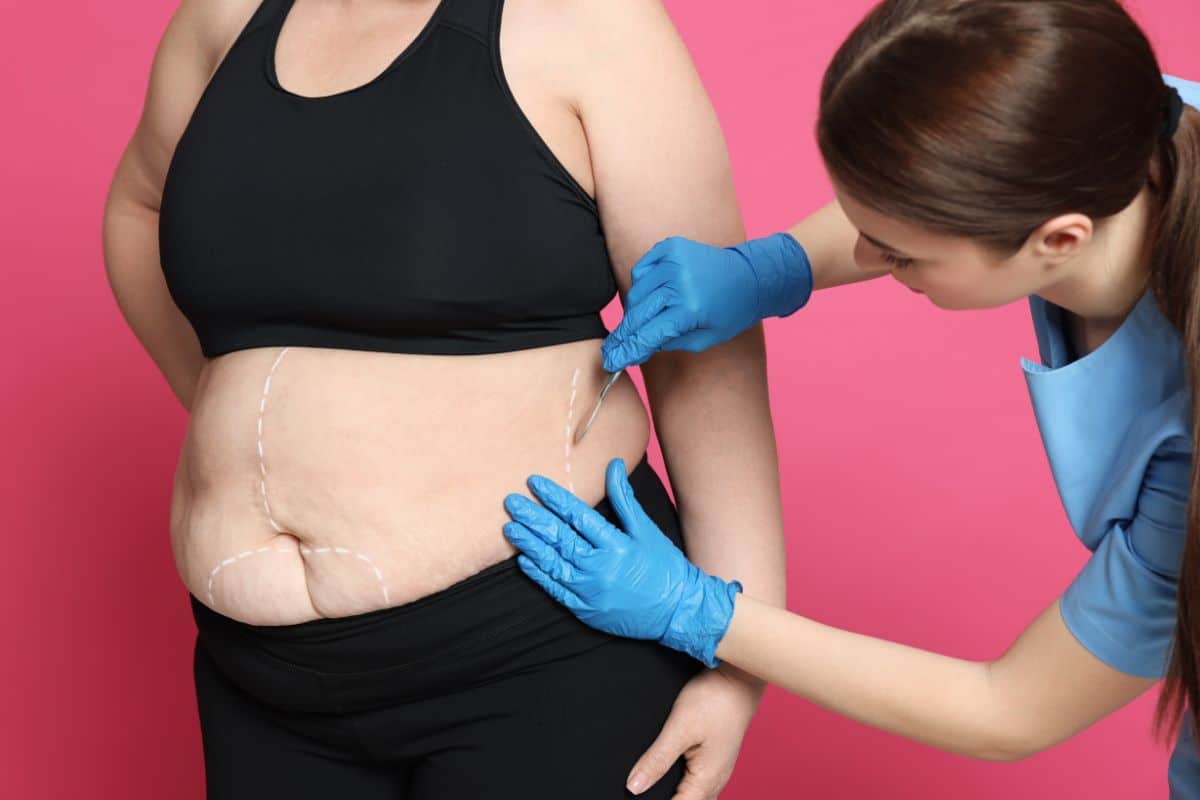 Conheça os tipos de cirurgia bariátrica e suas indicações 1 Tipos de cirurgia bariátrica.