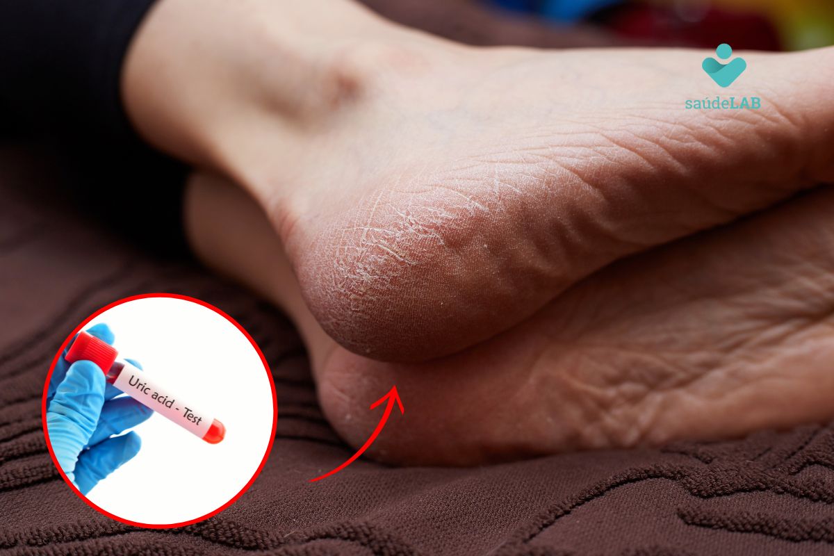 Ácido úrico elevado causa rachadura nos pés? Descubra a relação e como cuidar 1 ácido úrico elevado causa rachadura nos pés.