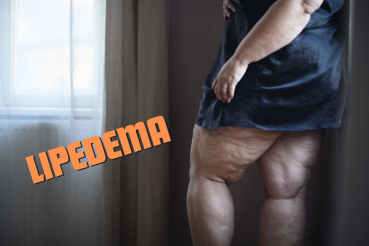O que é lipedema? Tudo que você sempre quis saber 1 O que é lipedema.