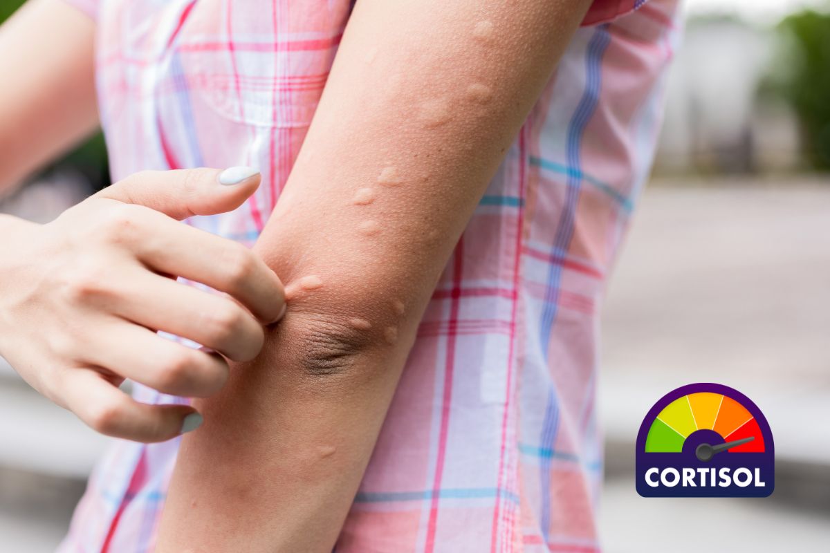 Alergia emocional: como o estresse pode impactar a saúde da sua pele 1 Alergia emocional.