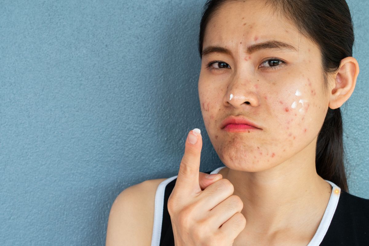 Tudo sobre a Acne: causas, tratamentos e dúvidas comuns 1 Acne.