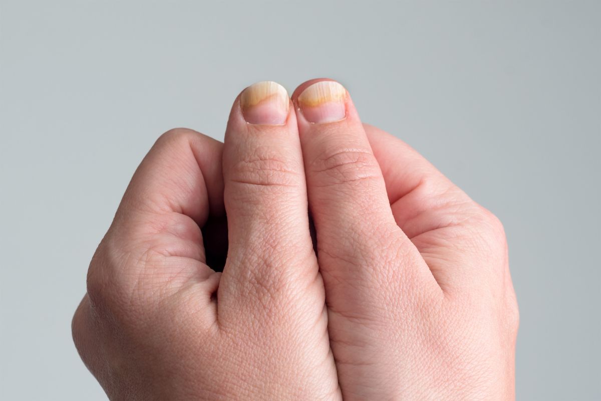 Como combater os fungos nas unhas: causas, sintomas e tratamentos eficazes 1 fungos nas unhas.
