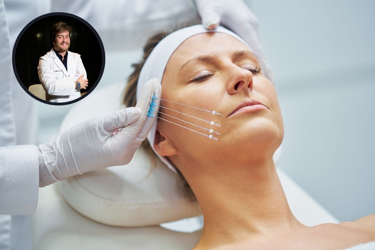 Fios de Sustentação: Rejuvenescimento Sem Cirurgia 1 Fios de sustentação.