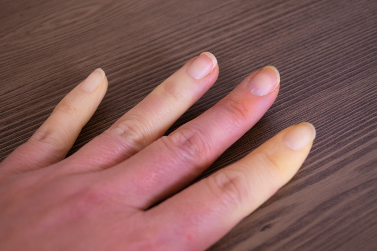 O que é Esclerodermia? Saiba por que a doença rara afeta mais mulheres 1 Esclerodermia.