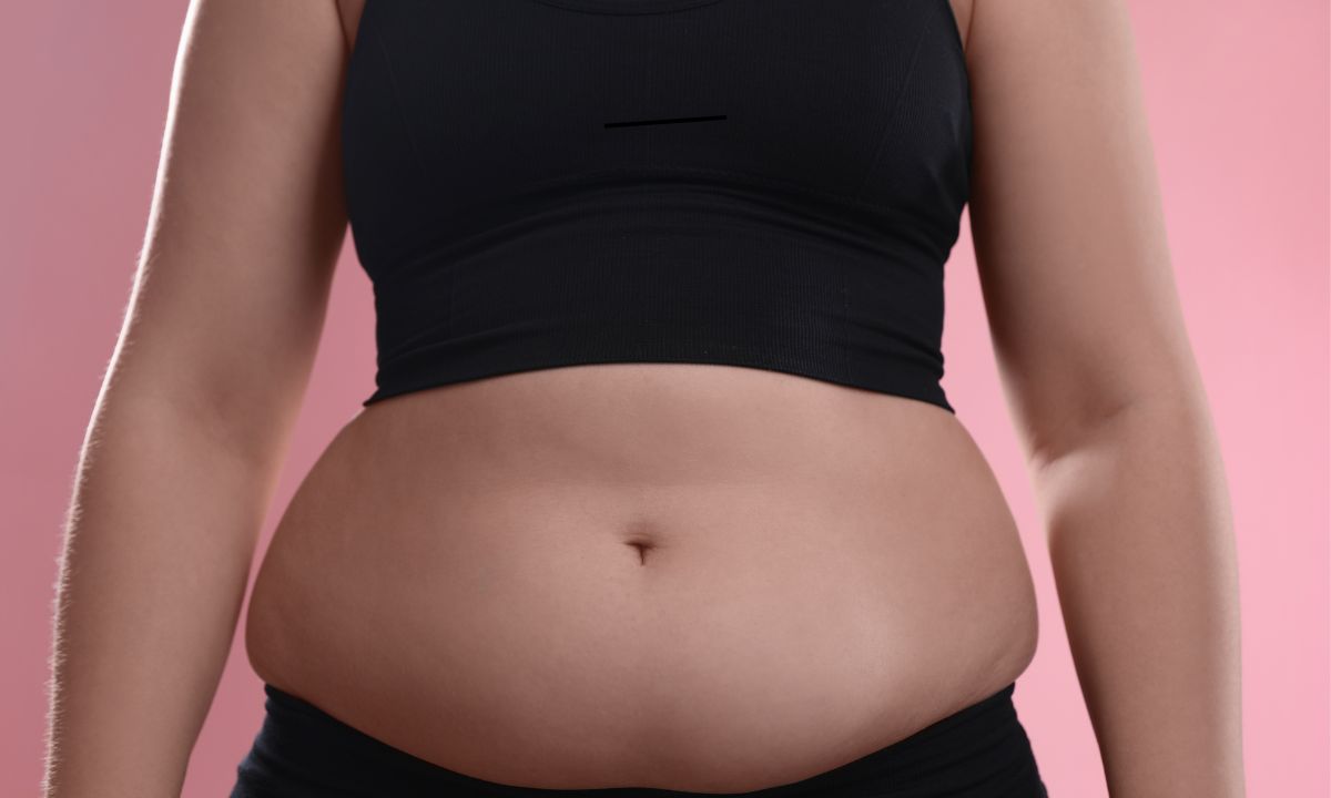 O que é lipodistrofia? Descubra os sintomas, causas e como identificar no seu corpo 1 Corpo feminino aparentando ter lipodistrofia.