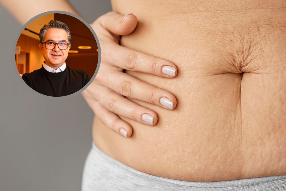 Diástase abdominal pós-parto: quando é hora de buscar ajuda? 1 diástase abdominal pós-parto.