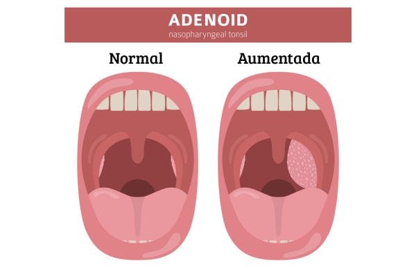 Hipertrofia de Adenoide: o que é, sintomas, tratamento e quando operar 2 Adenoide.