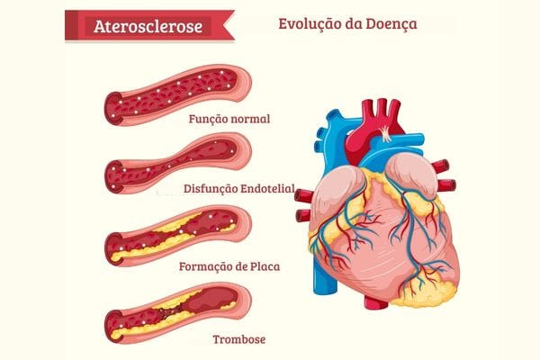 Sintomas da aterosclerose: sinais silenciosos que podem salvar sua vida se identificados cedo 2 Aterosclerose.