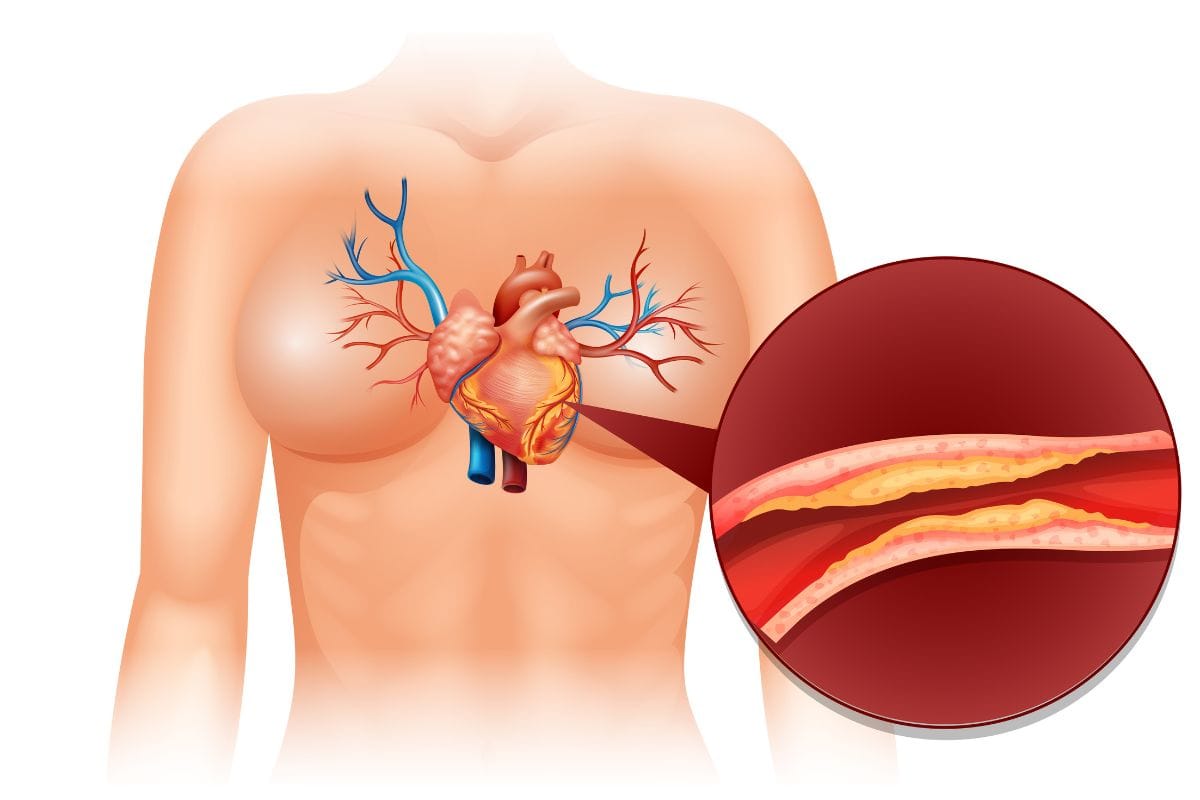 Sintomas da aterosclerose: sinais silenciosos que podem salvar sua vida se identificados cedo 1 sintomas da aterosclerose .