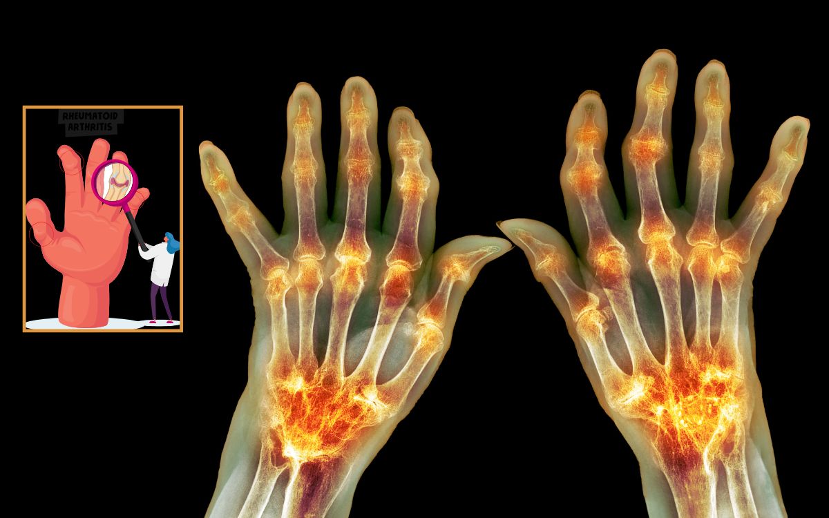Artrite reumatoide pode começar antes dos sintomas? Estudo aponta novidade 1 sinais iniciais da artrite reumatoide.